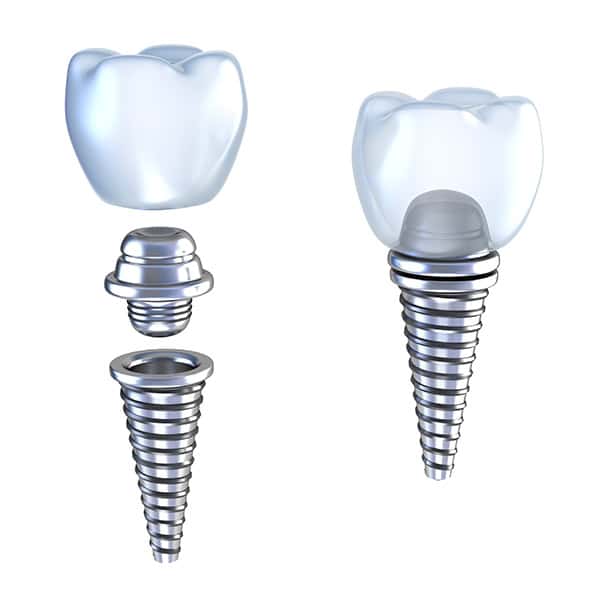 dental implants renton wa