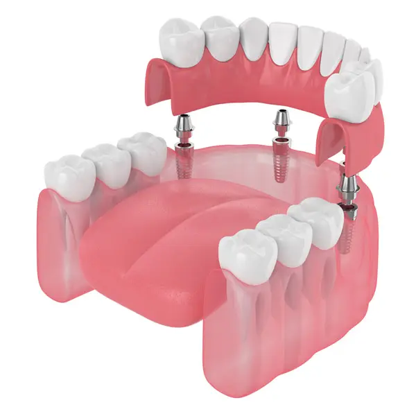 Trefoil Lower Arch Prosthesis in Renton