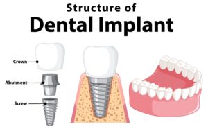 How to Find A Dental Implants Specialist in Renton WA