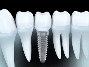 dental implants