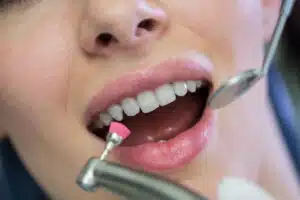 dental bonding Renton WA