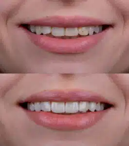 veneers Renton WA