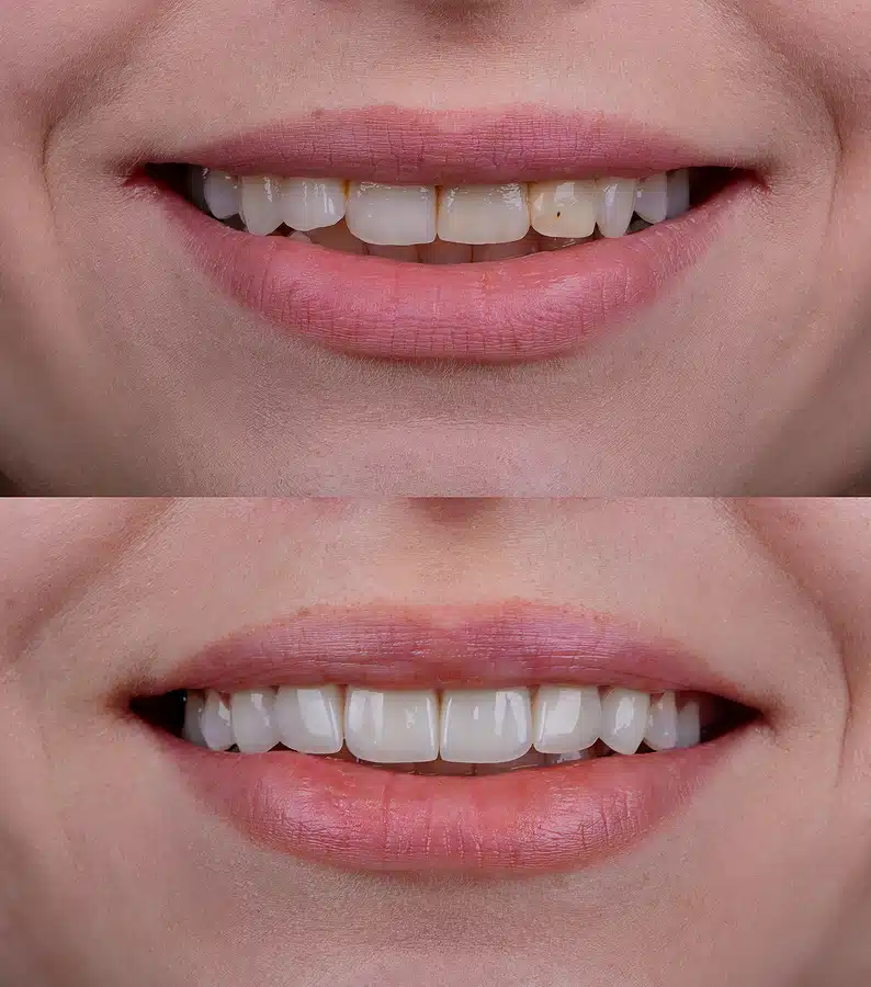 veneers Renton WA