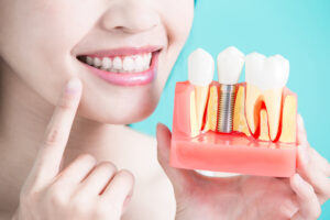 Close-up of dental implant