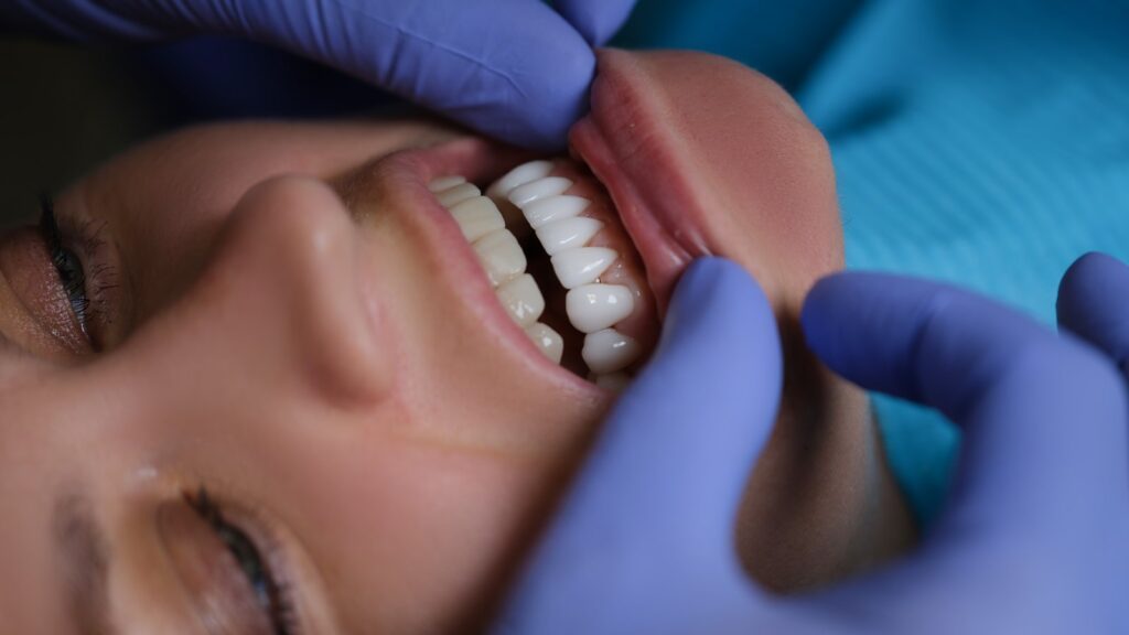 Doctor Dentist Examining Teeth With Veneers Of Female Patient In Clinic Closeup. Dentistry